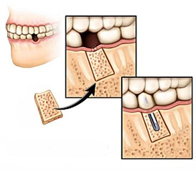 aditie os implant dentar