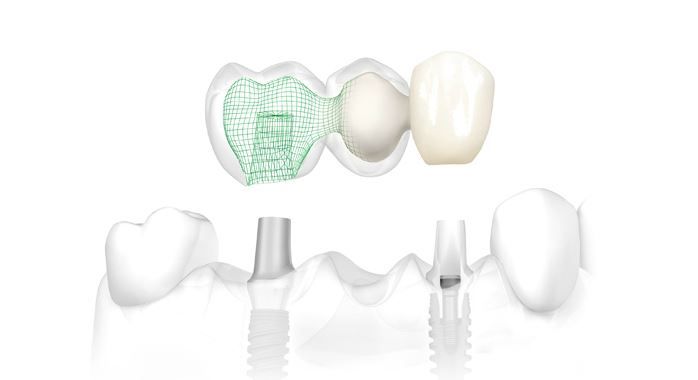contraindicatii-implant-dentar-2