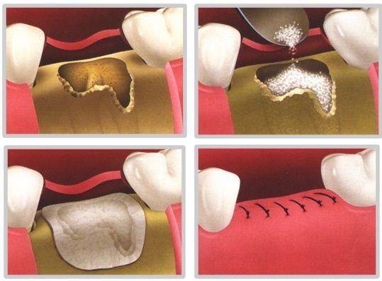 implant dentar grefa osoasa