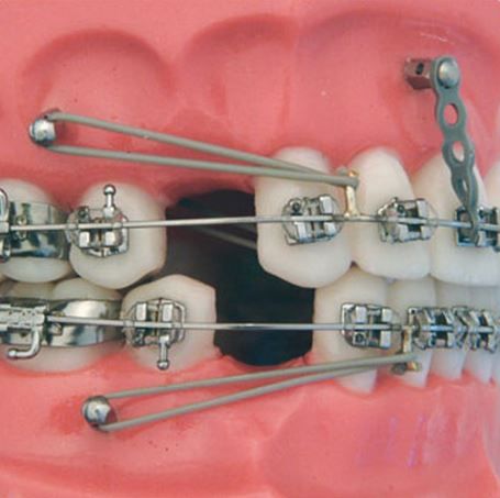 mini-implant-ortodontic-2