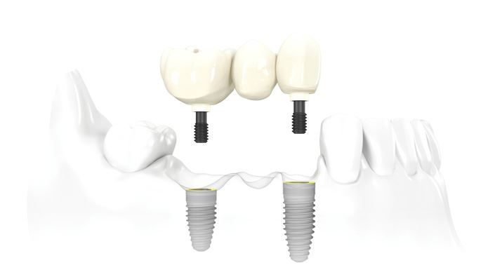 riscuri-implant-dentar-2