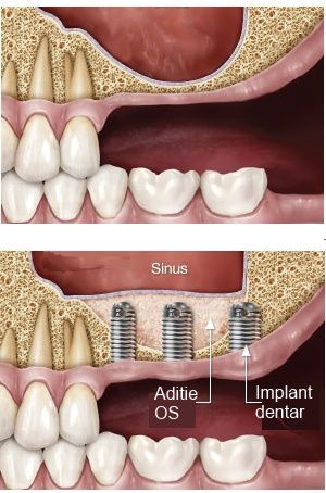 implant dentar sinus lift