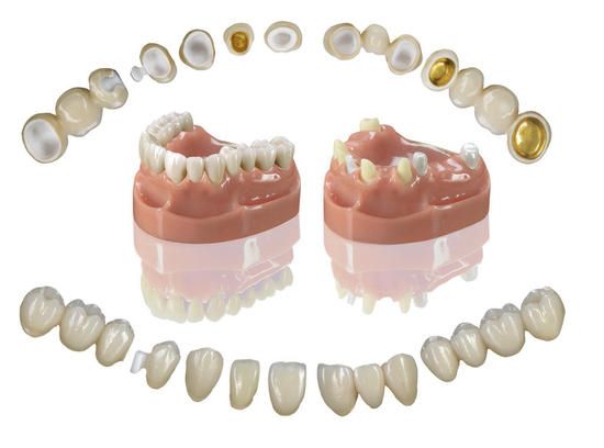 tipuri coroana dentara