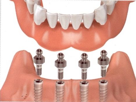 proteza dentara implante